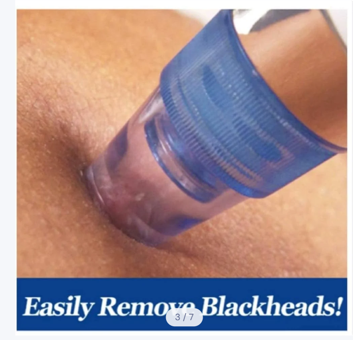Pore Vacuum Blackhead Remover – 5 Suction Levels & 4 Probes
